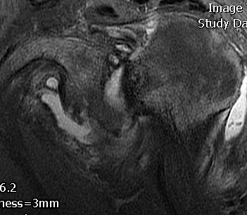 Chronic Posterior Shoulder Dislocation MRI Sagittal